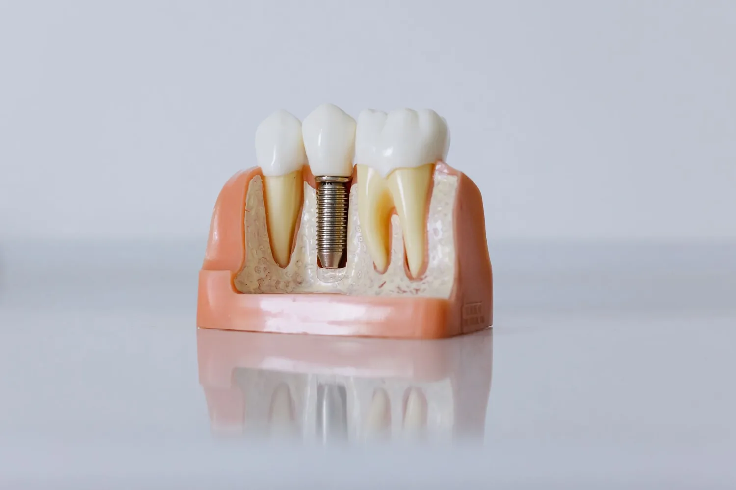 Implantes